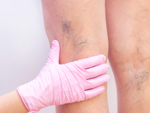 下肢静脈瘤の検査