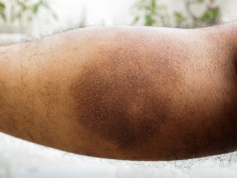 足の茶色いシミ